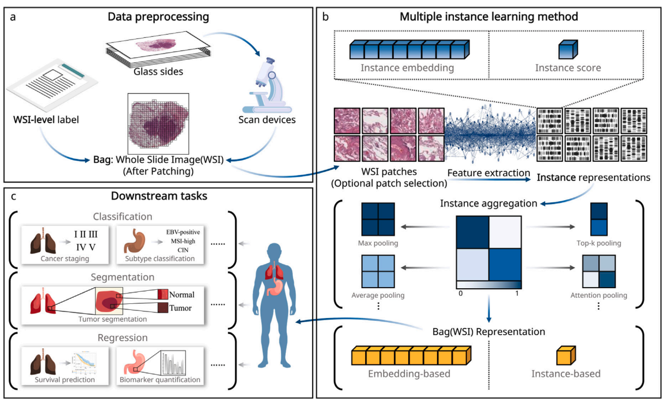 From patches to WSIs: A systematic review of deep Multiple Instance Learning in computational pathology