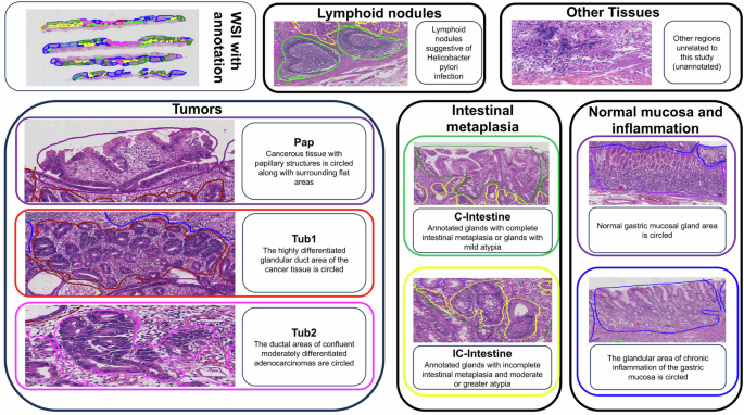 A fully annotated pathology slide dataset for early gastric cancer and precancerous lesions